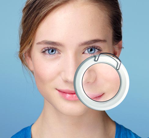 Причина угрей