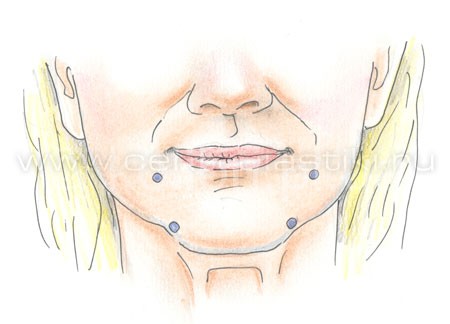 botox_udalenie_morschin_12