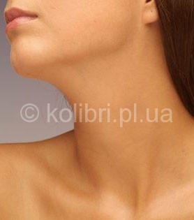 necklifting