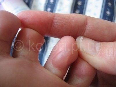 Водяная мозоль