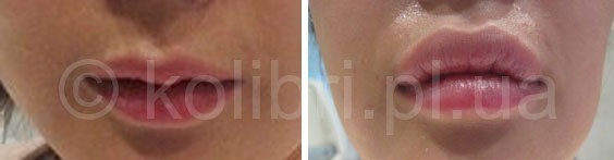 Специально отобранные филлеры на основе гиалуроновой кислоты