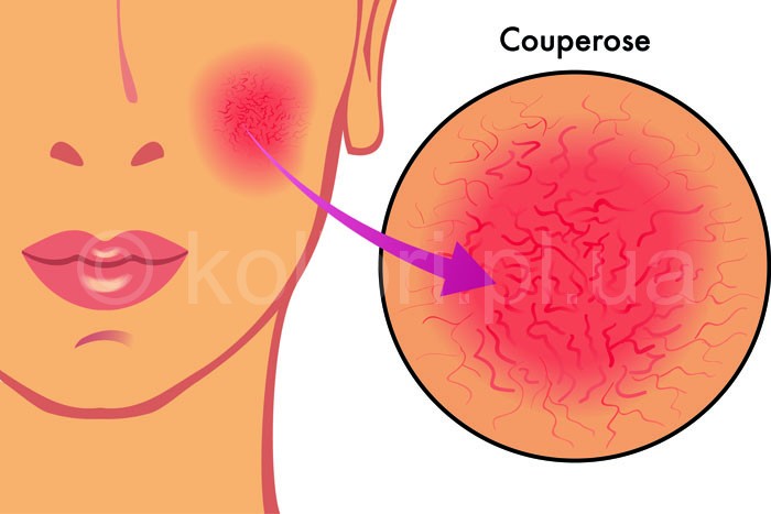 Румянец на щеках – признак здоровья или развития купероза?