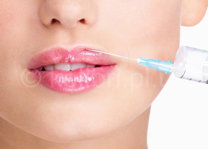 Увеличение губ: как добиться идеальных пропорций и омолаживающего эффекта